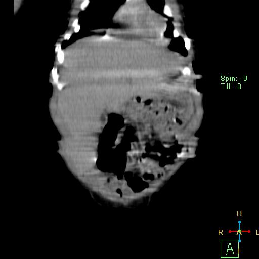 File:Neuroblastoma (Radiopaedia 24751-25016 B 4).jpg