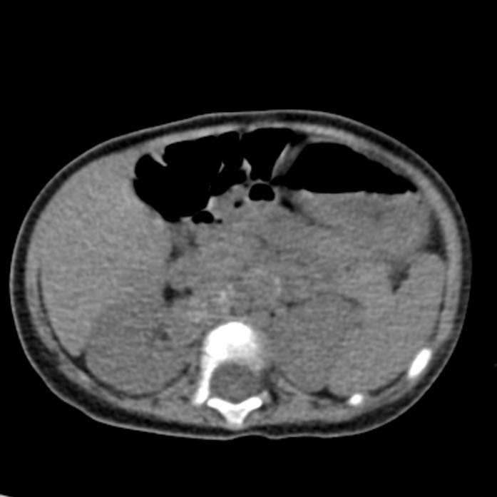 Neuroblastoma with skull metastases (Radiopaedia 30326-30960 Axial non-contrast 25).jpg