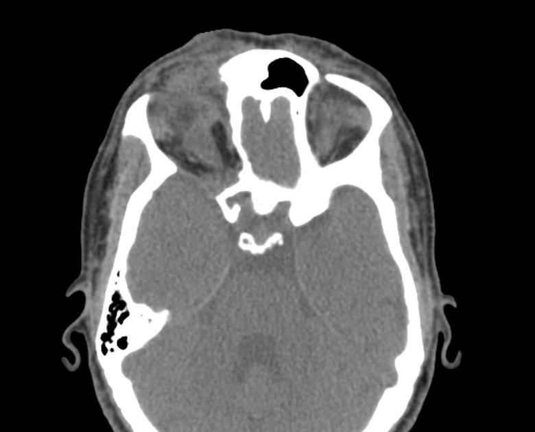 Neurofibromatosis type 1- orbital manifestations (Radiopaedia 49391-54511 Axial non-contrast 57).jpg