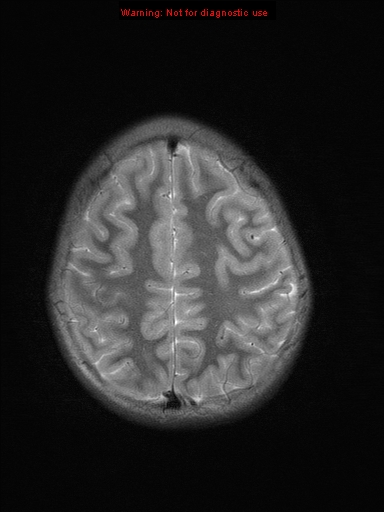 File:Neurofibromatosis type 1 with optic nerve glioma (Radiopaedia 16288-15965 Axial T2 6).jpg