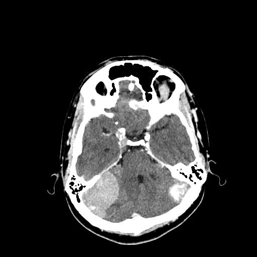 File:Neurofibromatosis type 2 (Radiopaedia 25389-25637 Axial C+ 23).jpg