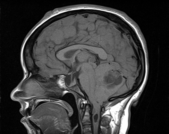 File:Neurofibromatosis type 2 (Radiopaedia 66211-75401 Sagittal T1 13).jpg