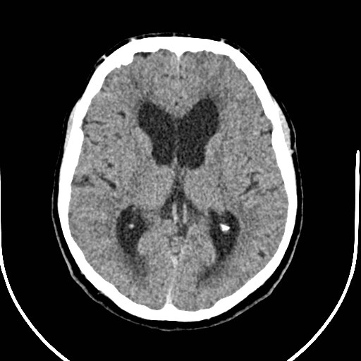 Neurofibromatosis type 2 (Radiopaedia 79097-92047 Axial non-contrast 32).jpg