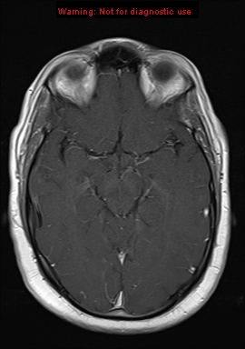 File:Neuroglial cyst (Radiopaedia 10713-11184 Axial T1 C+ 14).jpg