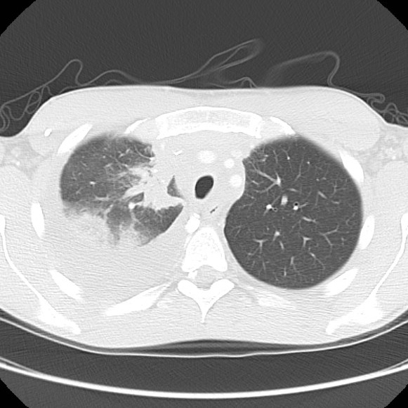 File:Non-Hodgkin lymphoma involving lung (Radiopaedia 29094-29470 Axial lung window 20).jpg