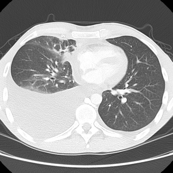 File:Non-Hodgkin lymphoma involving lung (Radiopaedia 29094-29470 Axial lung window 42).jpg