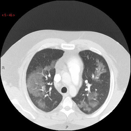 File:Non-specific interstitial pneumonitis (Radiopaedia 27044-27222 Axial lung window 37).jpg