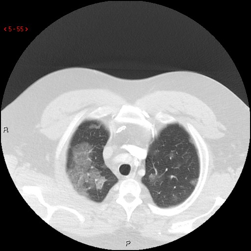 File:Non-specific interstitial pneumonitis (Radiopaedia 27044-27222 Axial lung window 46).jpg
