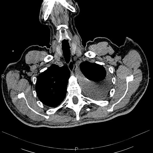 File:Non Hodgkin lymphoma in a patient with ankylosing spondylitis (Radiopaedia 84323-99621 Axial non-contrast 4).jpg