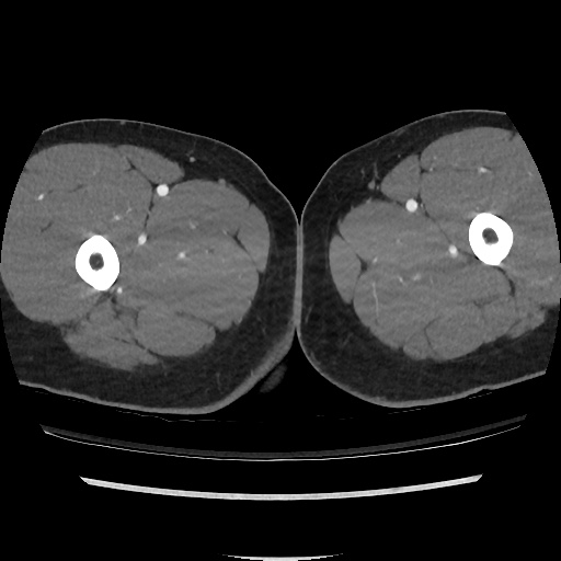 File:Normal CT angiogram of pelvis (Radiopaedia 45390-49430 A 75).jpg