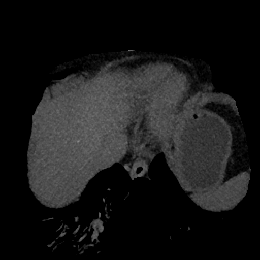 File:Normal CT intravenous cholangiogram (Radiopaedia 38199-40208 Axial IVC (MIP) 86).png