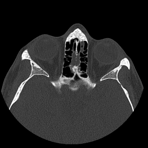 Normal CT paranasal sinuses (Radiopaedia 42286-45390 Axial bone window 41).jpg