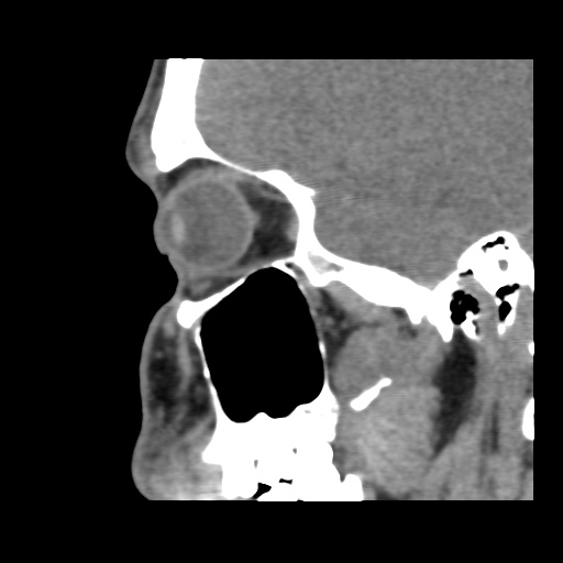 Normal CT paranasal sinuses (Radiopaedia 42286-45390 F 106).jpg