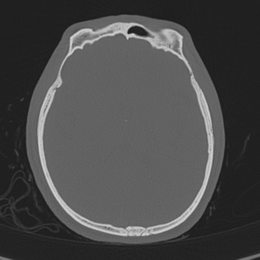 Normal CT skull (Radiopaedia 40798-43459 A 86).png
