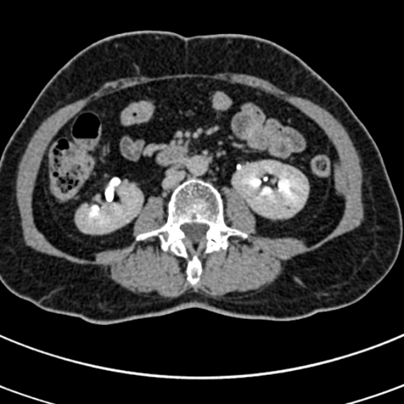 File:Normal CT split bolus study of the renal tract (Radiopaedia 48631-53634 Axial split bolus 123).jpg