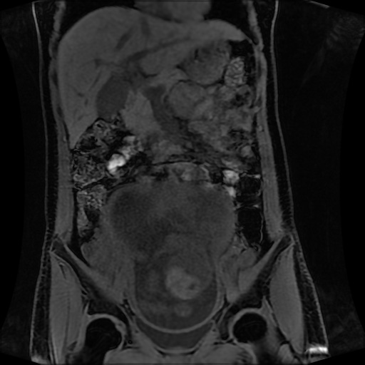 Normal MRI abdomen in pregnancy (Radiopaedia 88001-104541 M 63).jpg