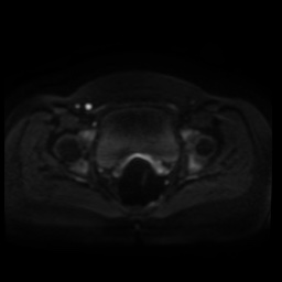 Normal MRI abdomen in pregnancy (Radiopaedia 88005-104548 Axial DWI 85).jpg