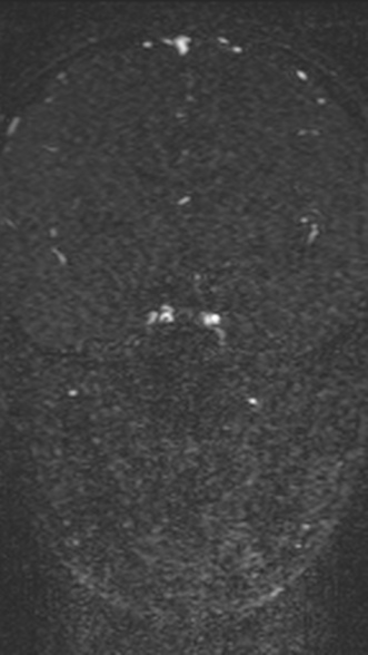 Normal MRI brain with MRV- teenager (Radiopaedia 49425-54553 Coronal MRV 120).jpg