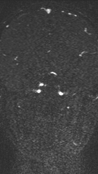 Normal MRI brain with MRV- teenager (Radiopaedia 49425-54553 Coronal MRV 126).jpg