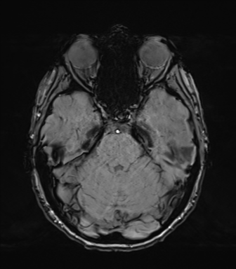 Normal brain MRI (TLE protocol) (Radiopaedia 40748-43405 Axial SWI 28).png