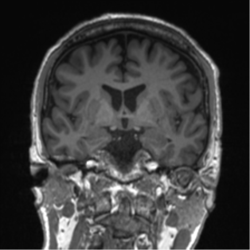 Normal brain MRI (non-focal epilepsy protocol) (Radiopaedia 53917-60040 Coronal T1 39).png