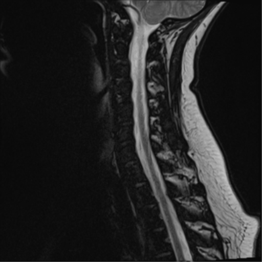 File:Normal cervical spine MRI (including Dixon) (Radiopaedia 42762-45925 Dixon- opposed phase 10).png