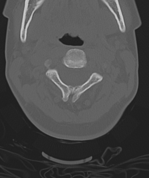Normal cervical spine MRI (including Dixon) (Radiopaedia 42762-45926 Axial bone window 19).png