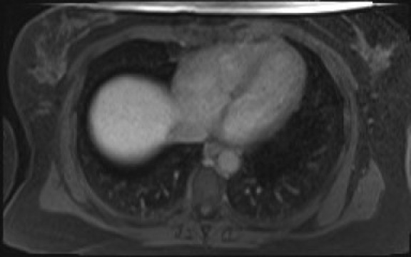 File:Normal hepatobiliary phase liver MRI (Radiopaedia 58968-66230 A 11).jpg