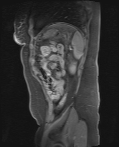 File:Normal hepatobiliary phase liver MRI (Radiopaedia 58968-66230 C 67).jpg