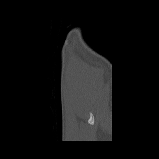 Normal pelvis (Radiopaedia 51473-57238 Sagittal bone window 145).jpg