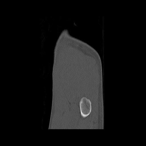 Normal pelvis (Radiopaedia 51473-57238 Sagittal bone window 7).jpg