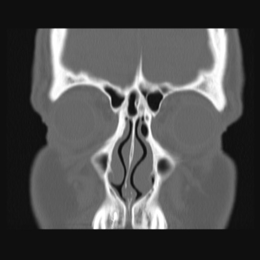 Normal sinus CT (annotated) (Radiopaedia 78917-91810 Coronal bone window 19).jpg