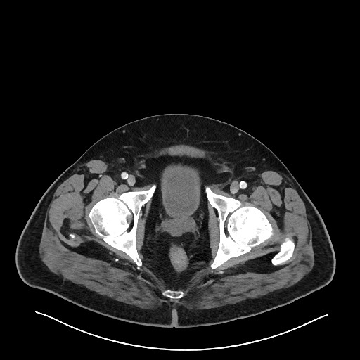 Obstructing sigmoid adenocarcinoma (Radiopaedia 58465-65619 A 155).jpg