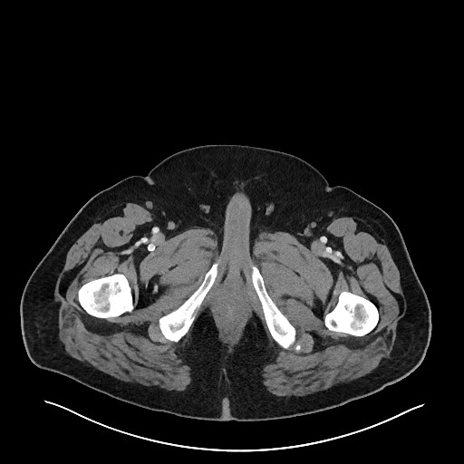 Obstructing sigmoid adenocarcinoma (Radiopaedia 58465-65619 A 174).jpg