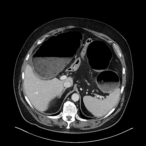 File:Obstructing sigmoid adenocarcinoma (Radiopaedia 58465-65619 A 43).jpg