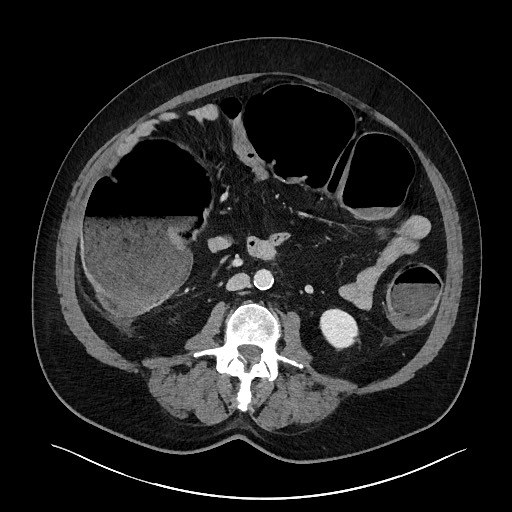 Obstructing sigmoid adenocarcinoma (Radiopaedia 58465-65619 A 85).jpg