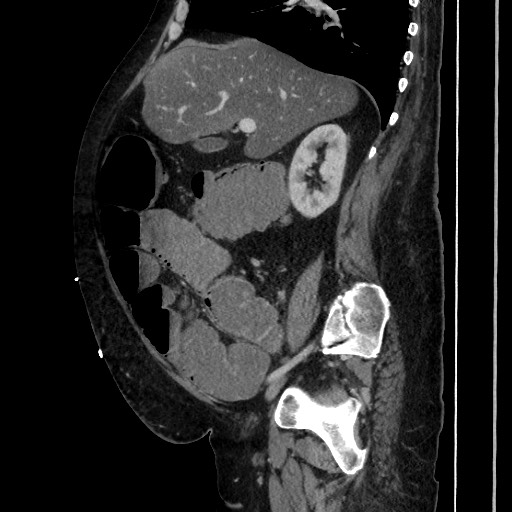 Obstructive colonic diverticular stricture (Radiopaedia 81085-94675 C 94).jpg