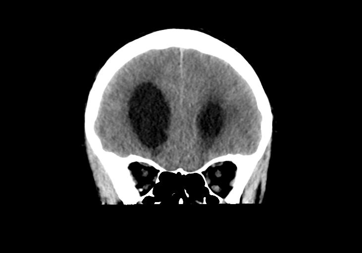 File:Obstructive hydrocephalus (Radiopaedia 30453-31119 Coronal non-contrast 11).jpg