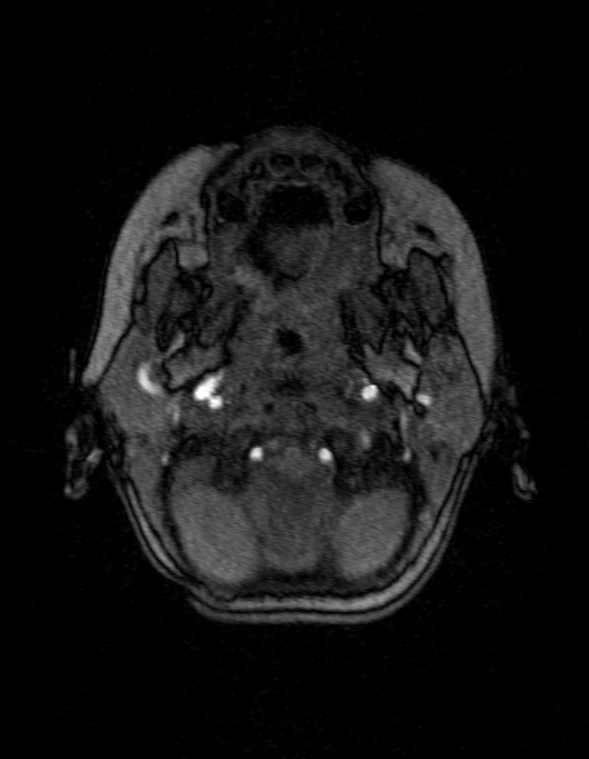 Occipital horn syndrome (Radiopaedia 14255-14129 MRA 13).jpg