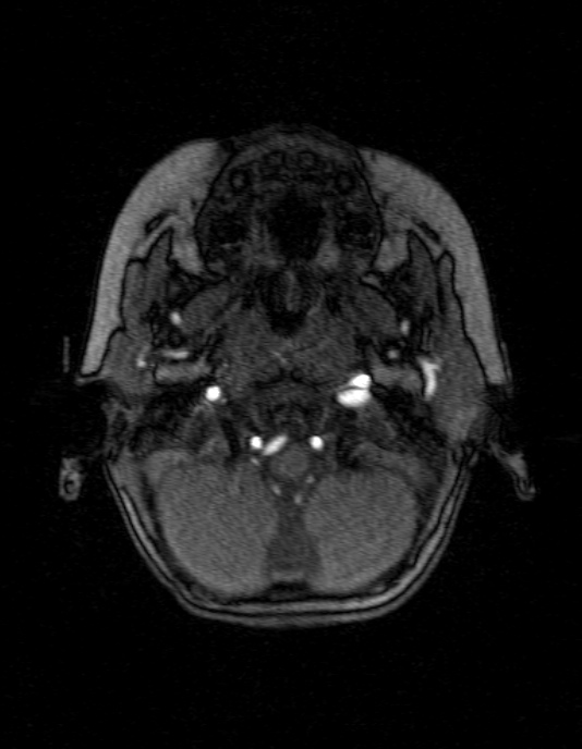 Occipital horn syndrome (Radiopaedia 14255-14129 MRA 18).jpg