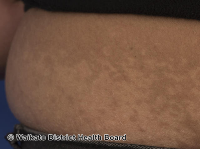 File:Postinflammatory hypopigmentation after recovery from dengue-like rash in a patient with suspected COVID19. (DermNet NZ covid-postinflammatory-007).jpg