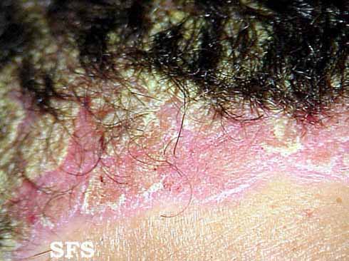 File:Psoriasis (Dermatology Atlas 13).jpg