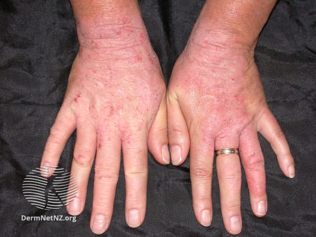 File:Rubber dermatitis (DermNet NZ dermatitis-rubber1).jpg