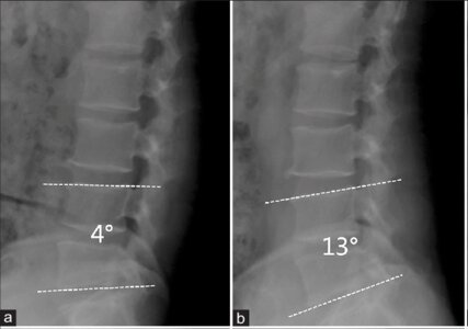 Individual with lumbar spinal stenosis (without spondylolisthesis)