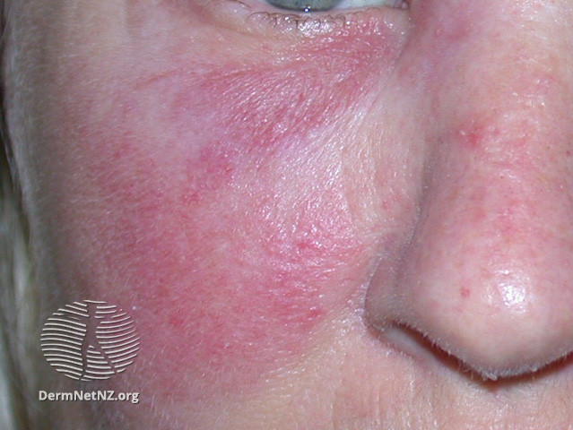 File:(DermNet NZ dermatitis-acd-face-2433).jpg