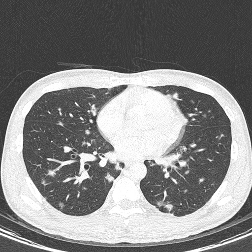 AIDS-related Kaposi sarcoma (Radiopaedia 85247-100811 Axial lung window 103).jpg