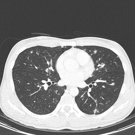AIDS-related Kaposi sarcoma (Radiopaedia 85247-100811 Axial lung window 94).jpg