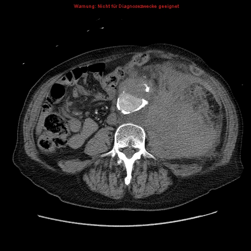 Abdominal aortic aneurysm- extremely large, ruptured (Radiopaedia 19882-19921 Axial C+ arterial phase 43).jpg