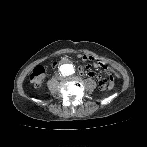 Abdominal aortic aneurysm (Radiopaedia 13341-13340 Axial C+ arterial phase 139).jpg