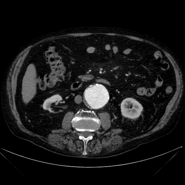 Abdominal aortic aneurysm (Radiopaedia 25855-26001 Axial C+ arterial phase 63).jpg